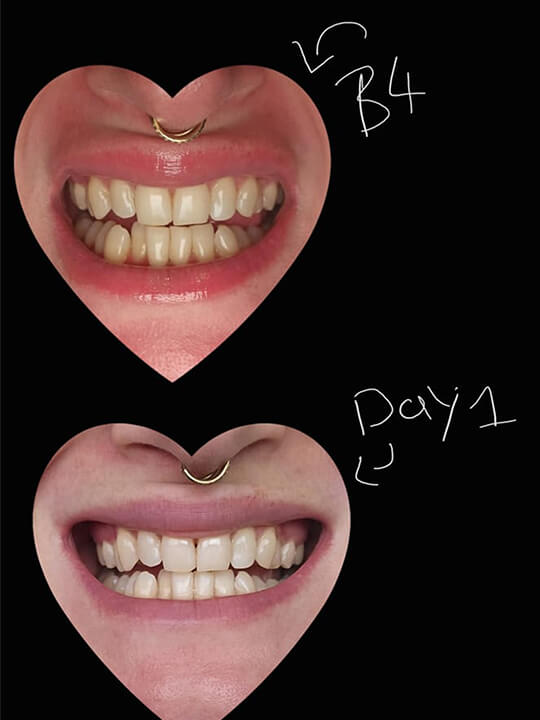 Smileflex® ultraLED™ Whitening Kit