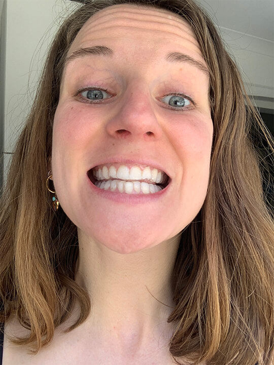 Smileflex® Pro Custom Whitening Kit